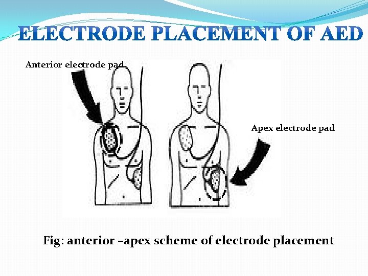 Anterior electrode pad Apex electrode pad Fig: anterior –apex scheme of electrode placement 