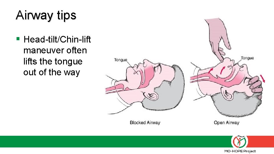 Airway tips § Head-tilt/Chin-lift maneuver often lifts the tongue out of the way Airway tips § Head-tilt/Chin-lift maneuver often lifts the tongue out of the way