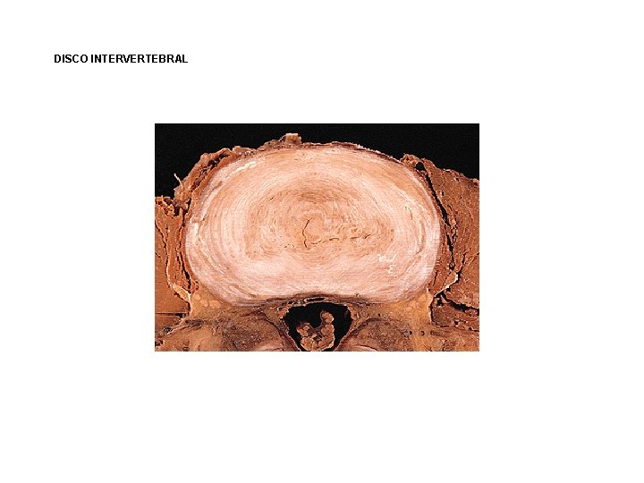 DISCO INTERVERTEBRAL DISCO INTERVERTEBRAL
