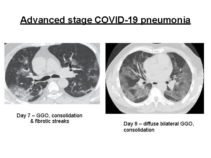 Advanced stage COVID-19 pneumonia Day 7 – GGO, consolidation & fibrotic streaks Day 8