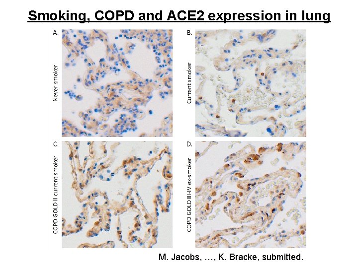 Smoking, COPD and ACE 2 expression in lung M. Jacobs, …, K. Bracke, submitted.