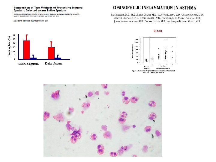 Eosinophils (%) Blood 30 25 20 15 10 5 0 Selected Sputum Entire Sputum