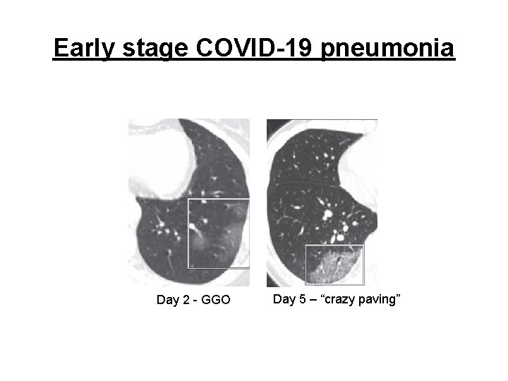 Early stage COVID-19 pneumonia Day 2 - GGO Day 5 – “crazy paving” 