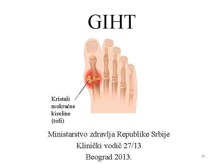 GIHT Kristali mokraćne kiseline (tofi) Ministarstvo zdravlja Republike Srbije Klinički vodič 27/13 Beograd 2013.