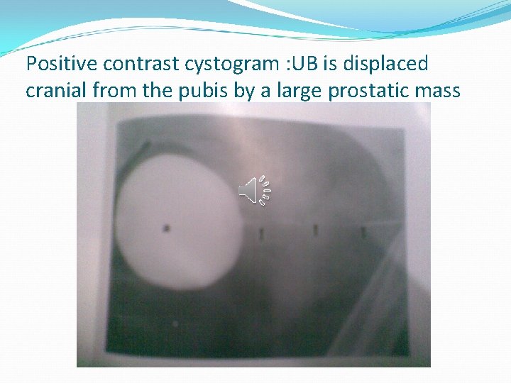 Positive contrast cystogram : UB is displaced cranial from the pubis by a large