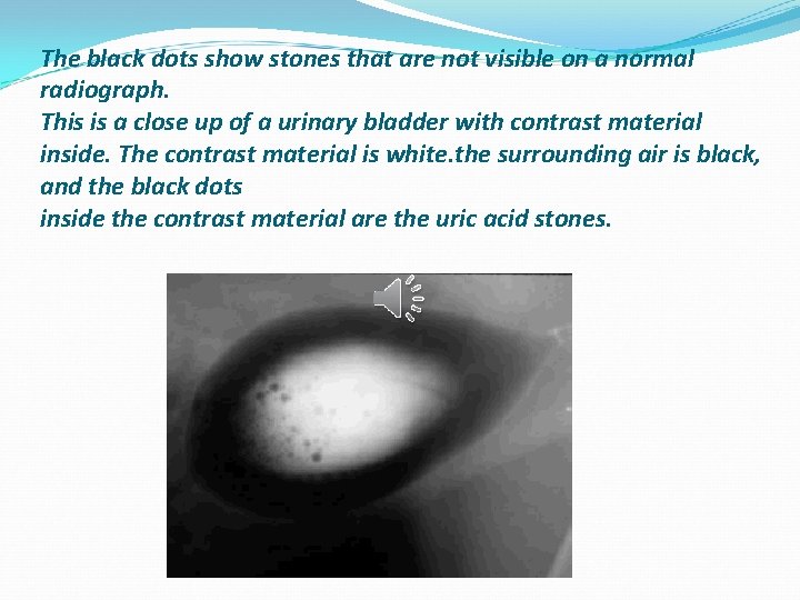 The black dots show stones that are not visible on a normal radiograph. This