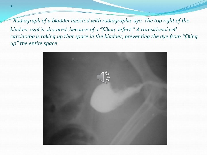 . Radiograph of a bladder injected with radiographic dye. The top right of the