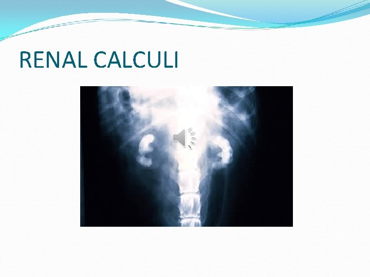 RENAL CALCULI 