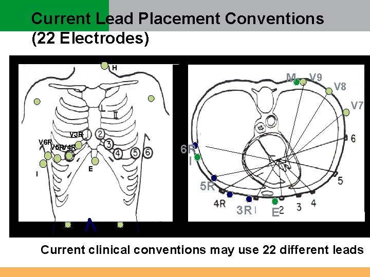 Current Lead Placement Conventions (22 Electrodes) H M V 9 V 8 V 7 Current Lead Placement Conventions (22 Electrodes) H M V 9 V 8 V 7