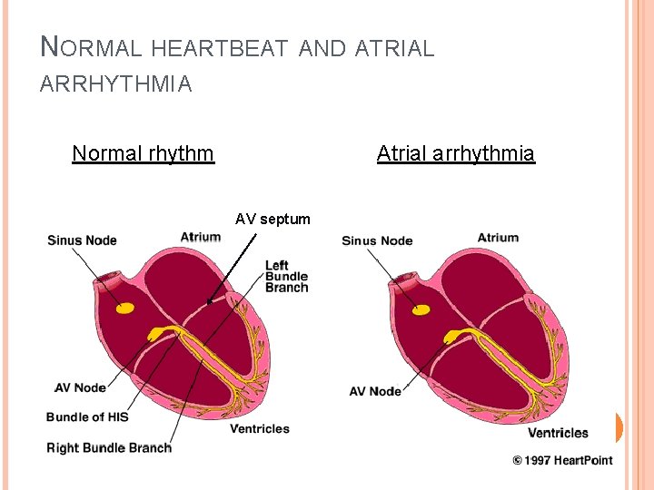 NORMAL HEARTBEAT AND ATRIAL ARRHYTHMIA Normal rhythm Atrial arrhythmia AV septum NORMAL HEARTBEAT AND ATRIAL ARRHYTHMIA Normal rhythm Atrial arrhythmia AV septum