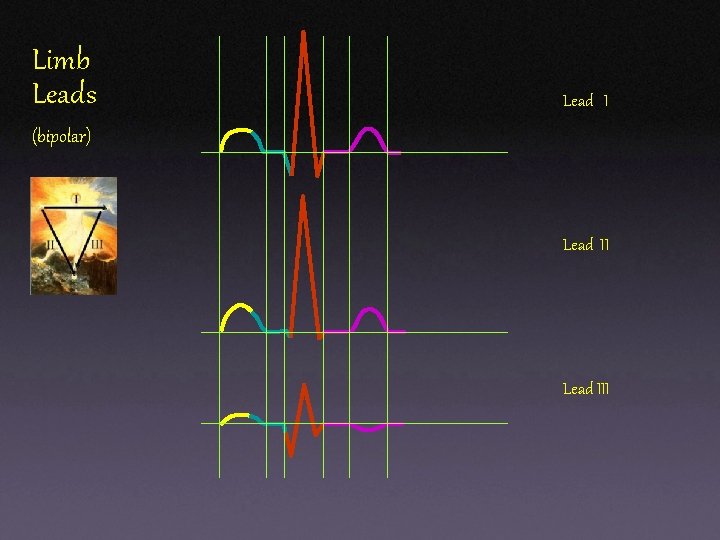 Limb Leads Lead I (bipolar) Lead III Limb Leads Lead I (bipolar) Lead III
