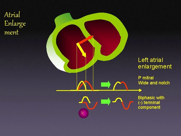 Atrial Enlarge ment Left atrial enlargement P mitral Wide and notch Biphasic with (-) Atrial Enlarge ment Left atrial enlargement P mitral Wide and notch Biphasic with (-)