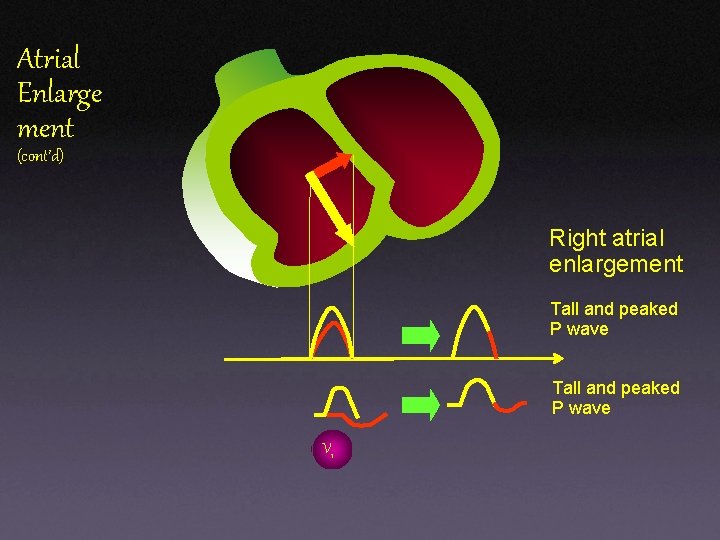 Atrial Enlarge ment (cont’d) Right atrial enlargement Tall and peaked P wave V 1 Atrial Enlarge ment (cont’d) Right atrial enlargement Tall and peaked P wave V 1