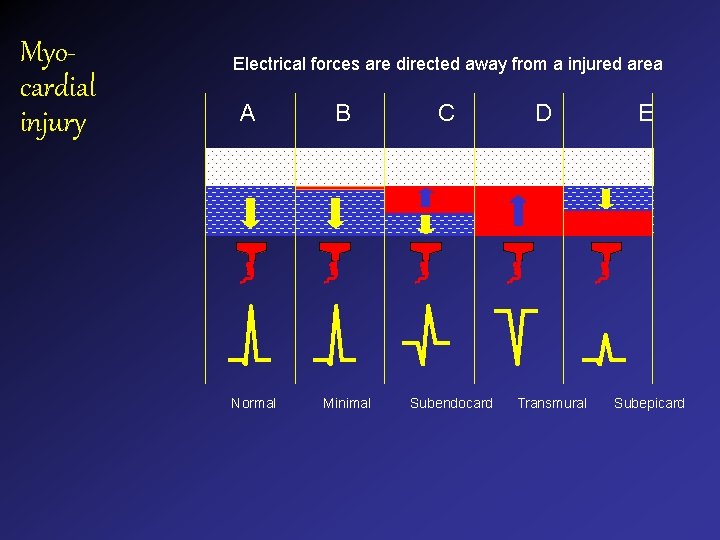 Myocardial injury Electrical forces are directed away from a injured area A Normal B Myocardial injury Electrical forces are directed away from a injured area A Normal B