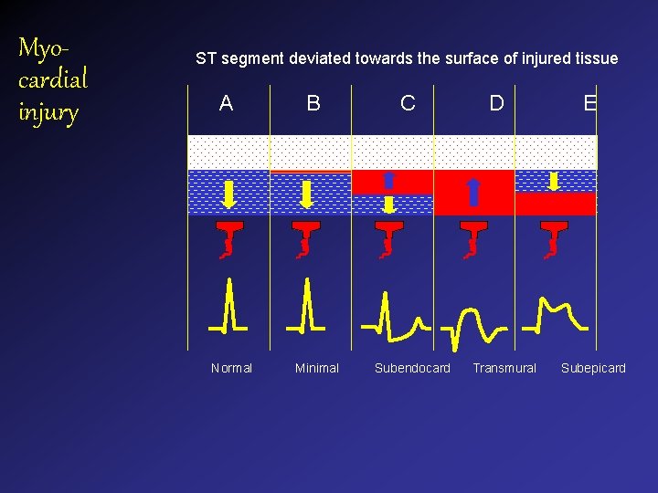 Myocardial injury ST segment deviated towards the surface of injured tissue A Normal B Myocardial injury ST segment deviated towards the surface of injured tissue A Normal B