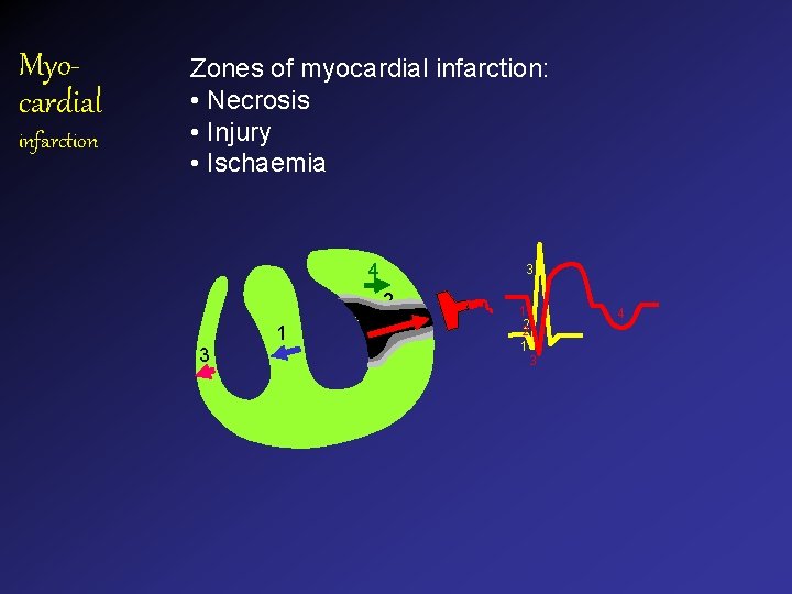 Myocardial infarction Zones of myocardial infarction: • Necrosis • Injury • Ischaemia 4 3 Myocardial infarction Zones of myocardial infarction: • Necrosis • Injury • Ischaemia 4 3
