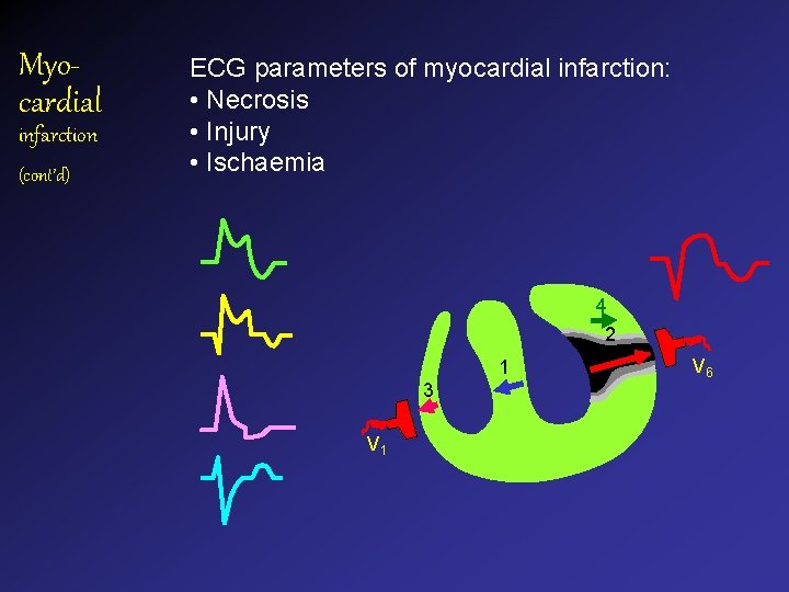 Myocardial infarction (cont’d) ECG parameters of myocardial infarction: • Necrosis • Injury • Ischaemia Myocardial infarction (cont’d) ECG parameters of myocardial infarction: • Necrosis • Injury • Ischaemia