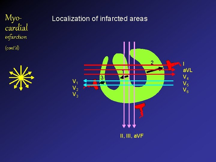 Myocardial Localization of infarcted areas infarction (cont’d) 2 1 V 2 V 3 3 Myocardial Localization of infarcted areas infarction (cont’d) 2 1 V 2 V 3 3