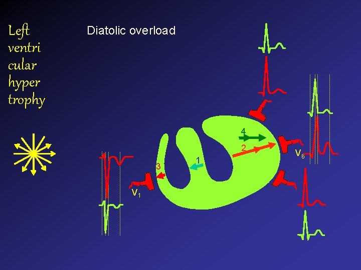 Left ventri cular hyper trophy Diatolic overload 4 2 3 V 1 1 V Left ventri cular hyper trophy Diatolic overload 4 2 3 V 1 1 V