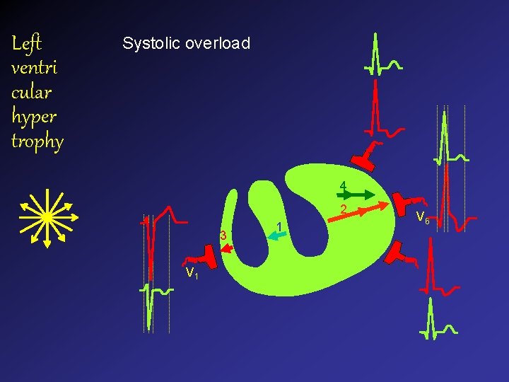 Left ventri cular hyper trophy Systolic overload 4 2 3 V 1 1 V Left ventri cular hyper trophy Systolic overload 4 2 3 V 1 1 V