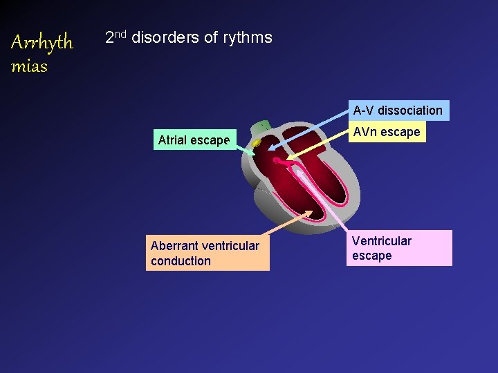 Arrhyth mias 2 nd disorders of rythms A-V dissociation Atrial escape Aberrant ventricular conduction Arrhyth mias 2 nd disorders of rythms A-V dissociation Atrial escape Aberrant ventricular conduction