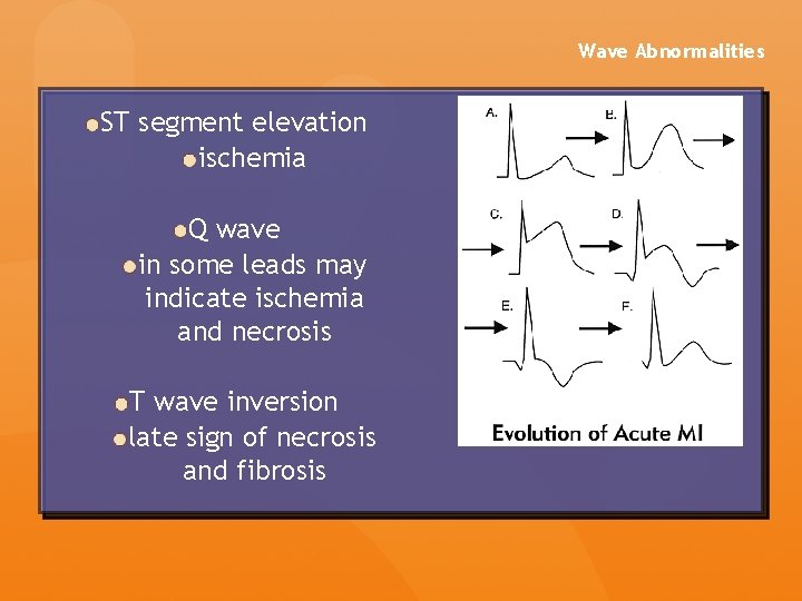 Wave Abnormalities ST segment elevation ischemia Q wave in some leads may indicate ischemia Wave Abnormalities ST segment elevation ischemia Q wave in some leads may indicate ischemia
