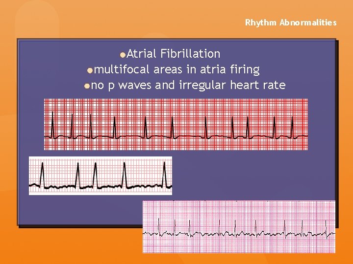 Rhythm Abnormalities Atrial Fibrillation multifocal areas in atria firing no p waves and irregular Rhythm Abnormalities Atrial Fibrillation multifocal areas in atria firing no p waves and irregular