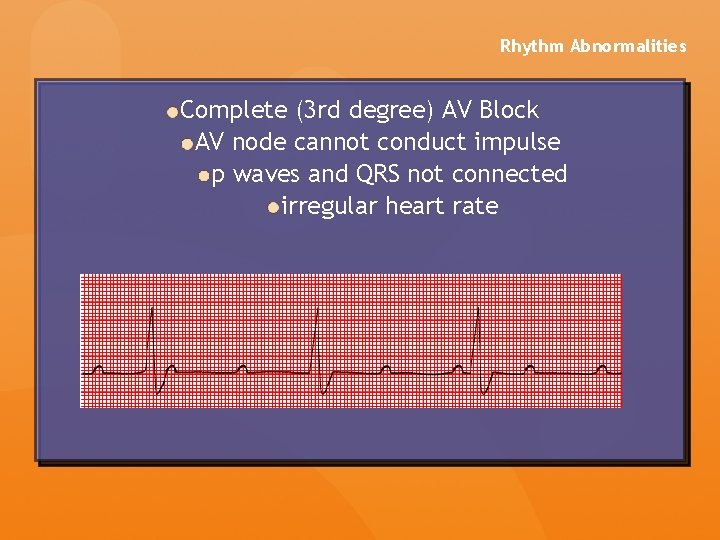 Rhythm Abnormalities Complete (3 rd degree) AV Block AV node cannot conduct impulse p Rhythm Abnormalities Complete (3 rd degree) AV Block AV node cannot conduct impulse p