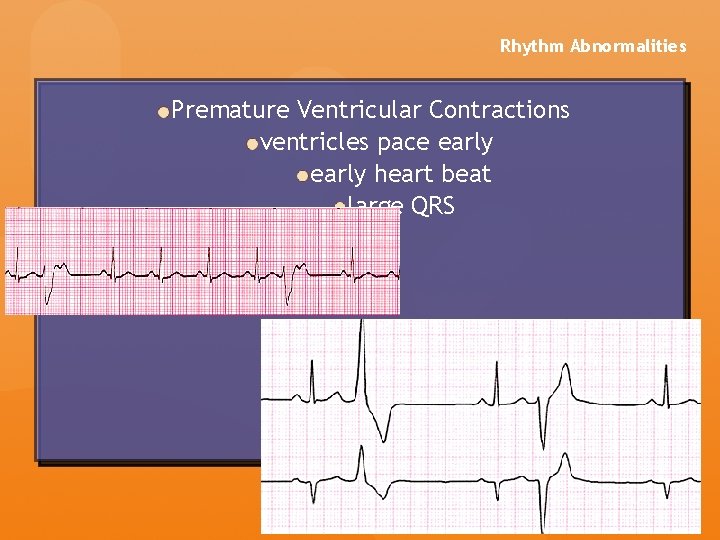 Rhythm Abnormalities Premature Ventricular Contractions ventricles pace early heart beat large QRS Rhythm Abnormalities Premature Ventricular Contractions ventricles pace early heart beat large QRS