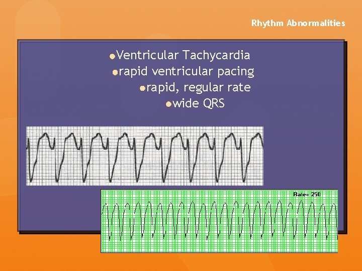 Rhythm Abnormalities Ventricular Tachycardia rapid ventricular pacing rapid, regular rate wide QRS Rhythm Abnormalities Ventricular Tachycardia rapid ventricular pacing rapid, regular rate wide QRS