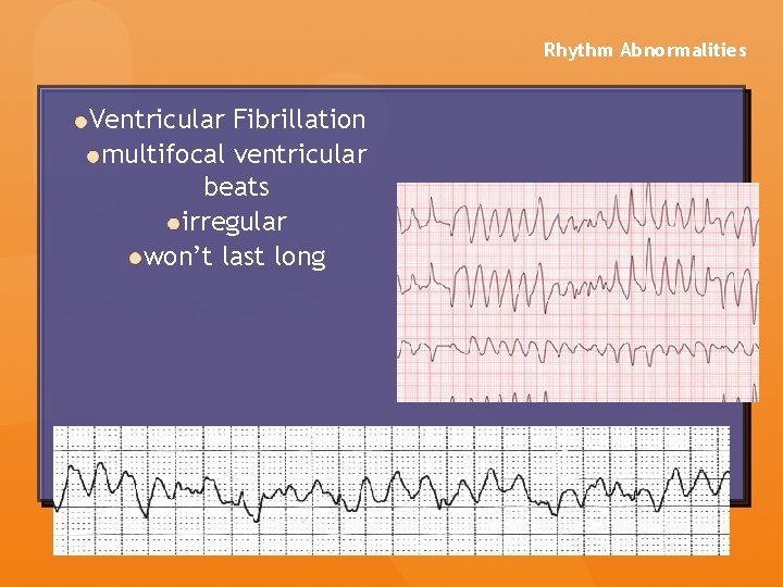 Rhythm Abnormalities Ventricular Fibrillation multifocal ventricular beats irregular won’t last long Rhythm Abnormalities Ventricular Fibrillation multifocal ventricular beats irregular won’t last long