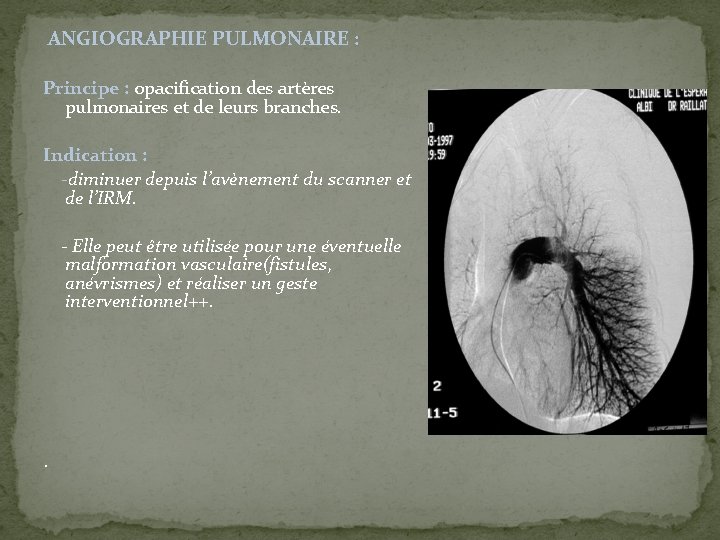  ANGIOGRAPHIE PULMONAIRE : Principe : opacification des artères pulmonaires et de leurs branches.