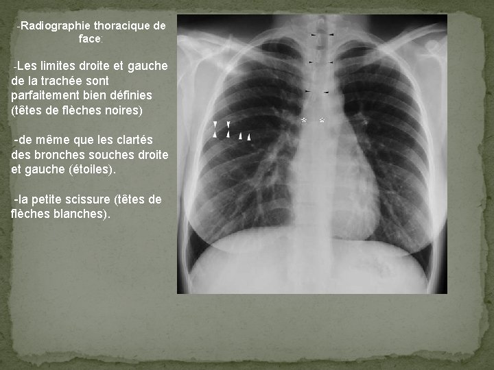 -Radiographie thoracique de face: -Les limites droite et gauche de la trachée sont parfaitement