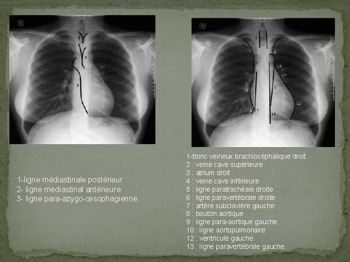 ligne de jonction médiastinale postérieure ; 2 : ligne de jonction mediastinal antérieure ;