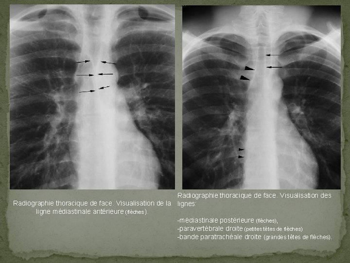 Radiographie thoracique de face. Visualisation des Radiographie thoracique de face. Visualisation de la lignes: