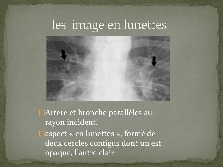  les image en lunettes �Artere et bronche parallèles au rayon incident. �aspect «