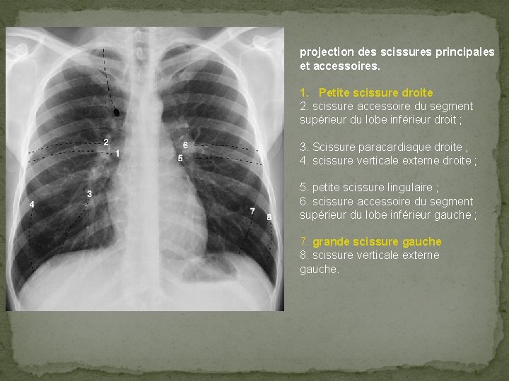 projection des scissures principales et accessoires. 1. Petite scissure droite 2. scissure accessoire du