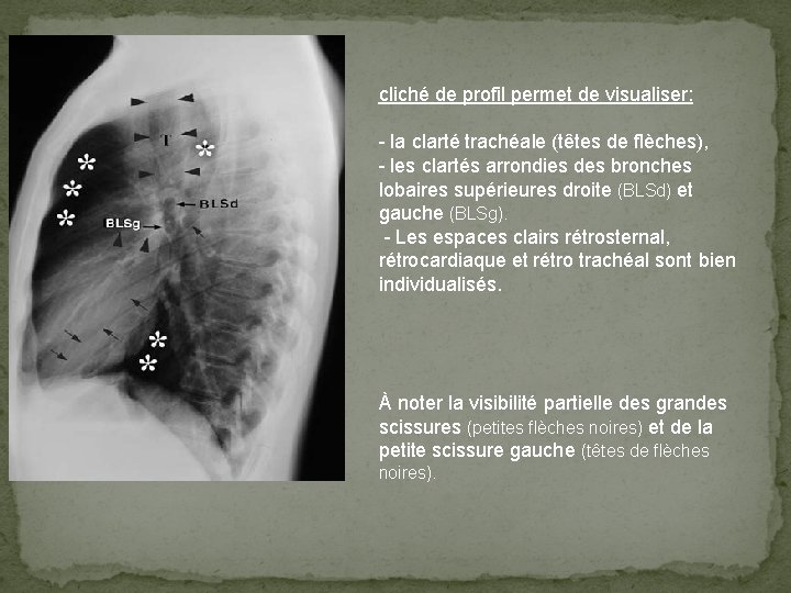 cliché de profil permet de visualiser: - la clarté trachéale (têtes de flèches), -