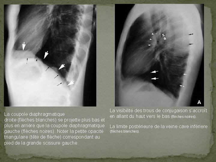 La visibilité des trous de conjugaison s’accroît La coupole diaphragmatique en allant du haut