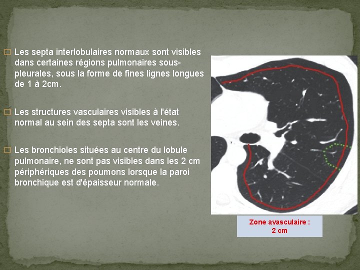 � Les septa interlobulaires normaux sont visibles dans certaines régions pulmonaires souspleurales, sous la