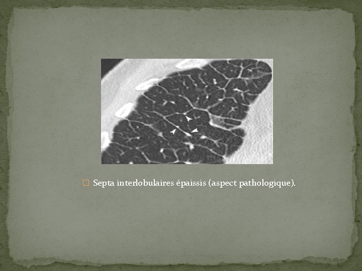 � Septa interlobulaires épaissis (aspect pathologique). 