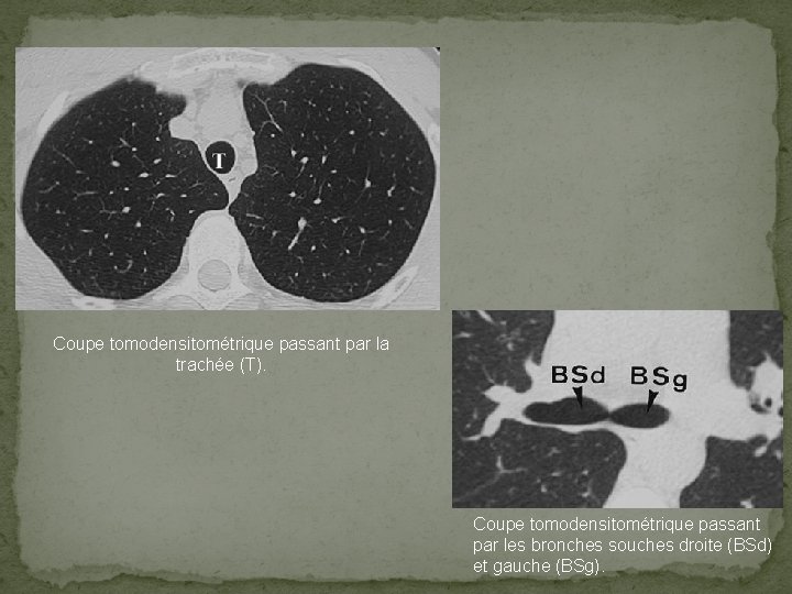 Coupe tomodensitométrique passant par la trachée (T). Coupe tomodensitométrique passant par les bronches souches