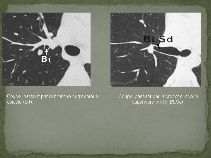 Coupe passant par la bronche segmentaire apicale (B 1). Coupe passant par la bronche