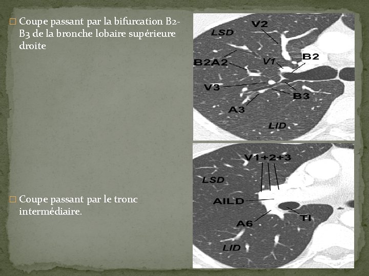 � Coupe passant par la bifurcation B 2 - B 3 de la bronche