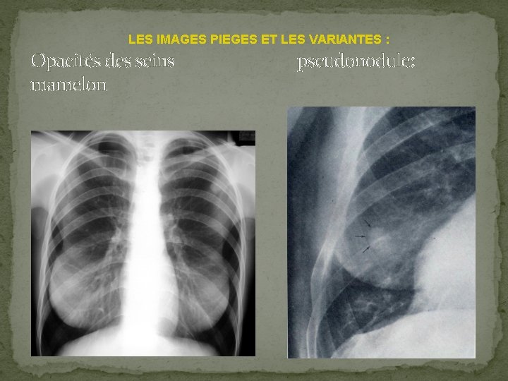 LES IMAGES PIEGES ET LES VARIANTES : Opacités des seins pseudonodule: mamelon 