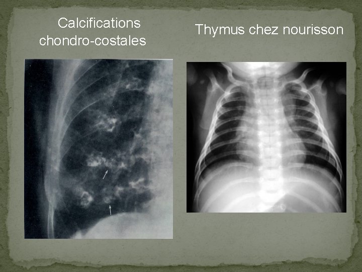  Calcifications chondro-costales Thymus chez nourisson 