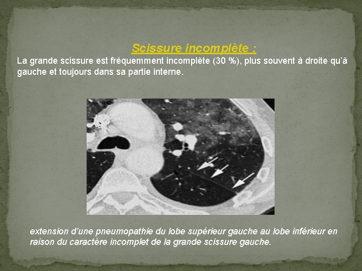  Scissure incomplète : La grande scissure est fréquemment incomplète (30 %), plus souvent