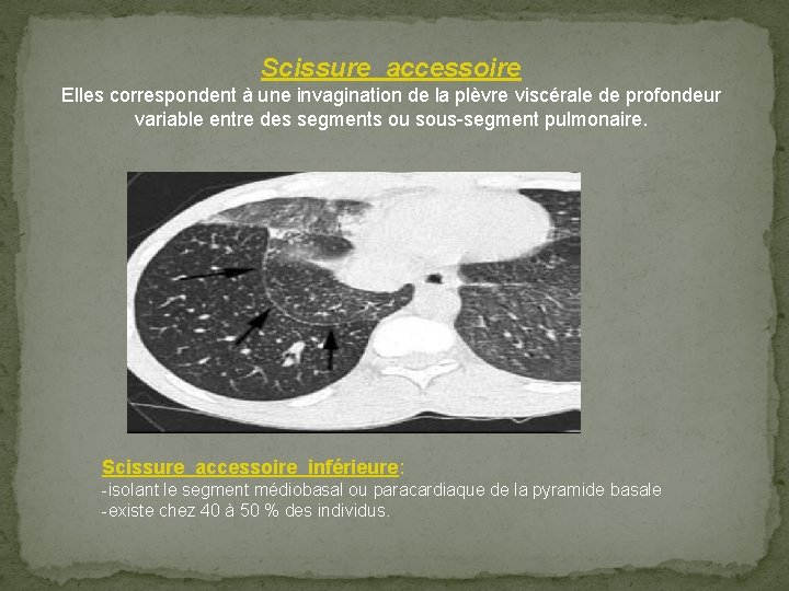 Scissure accessoire Elles correspondent à une invagination de la plèvre viscérale de profondeur variable