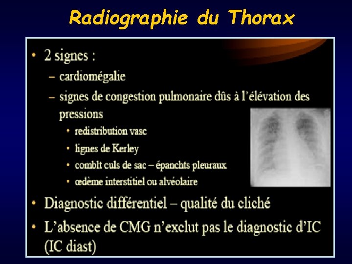 Radiographie du Thorax 