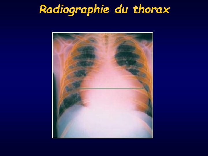 Radiographie du thorax 